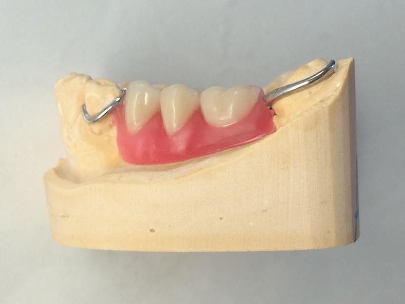 partial dentures 17